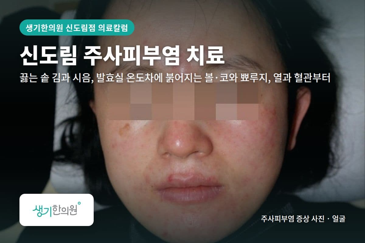 얼굴 주사피부염 증상 사진과 문구 「신도림 주사피부염 치료, 끓는 솥 김과 시음, 발효실 온도차에 붉어지는 볼·코와 뾰루지, 열과 혈관부터 · 생기한의원 신도림점」