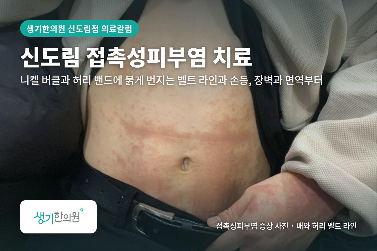 배와 허리 벨트 라인 접촉성피부염 증상 사진과 문구 「신도림 접촉성피부염 치료, 니켈 버클과 허리 밴드에 붉게 번지는 벨트 라인과 손등, 장벽과 면역부터 · 생기한의원 신도림점」