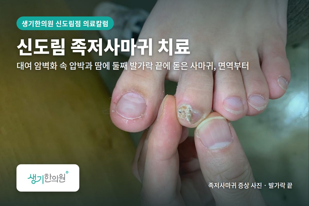발가락 끝 족저사마귀 증상 사진과 문구 「신도림 족저사마귀 치료, 대여 암벽화 속 압박과 땀에 둘째 발가락 끝에 돋은 사마귀, 면역부터 · 생기한의원 신도림점」