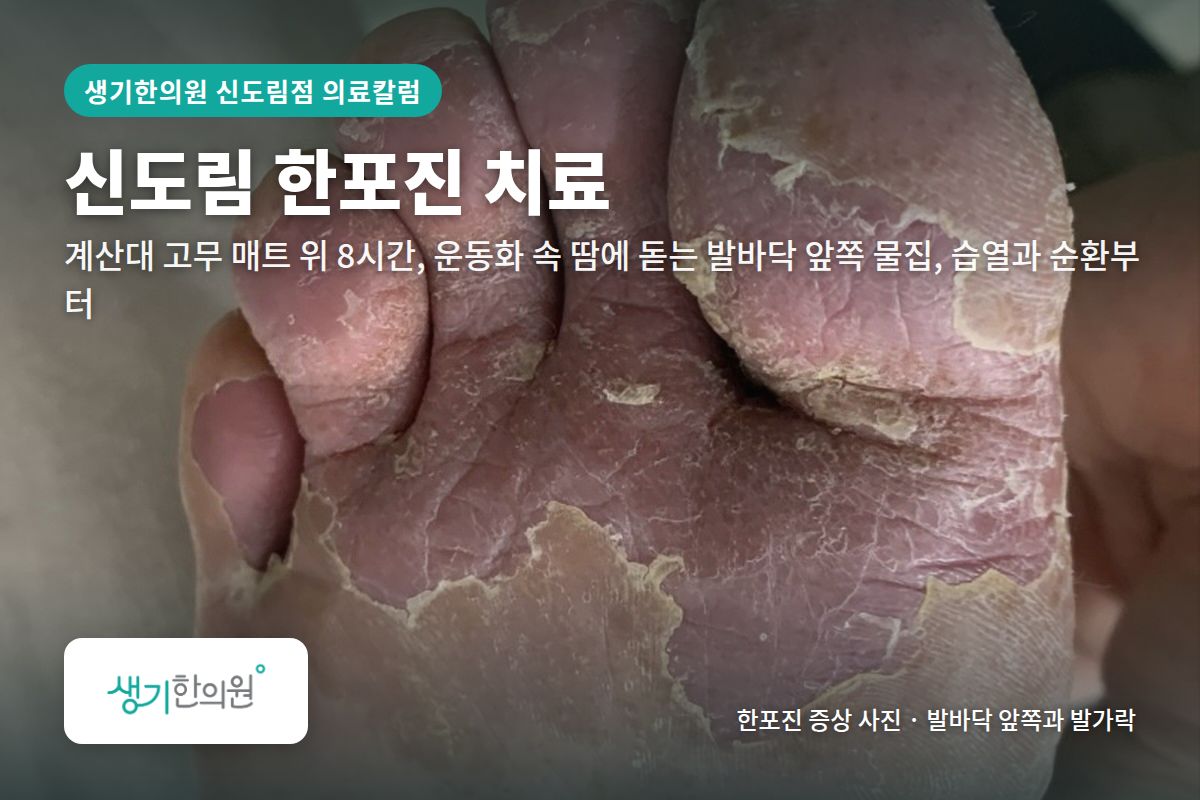 발바닥 앞쪽과 발가락 한포진 증상 사진과 문구 「신도림 한포진 치료, 계산대 고무 매트 위 8시간, 운동화 속 땀에 돋는 발바닥 앞쪽 물집, 습열과 순환부터 · 생기한의원 신도림점」