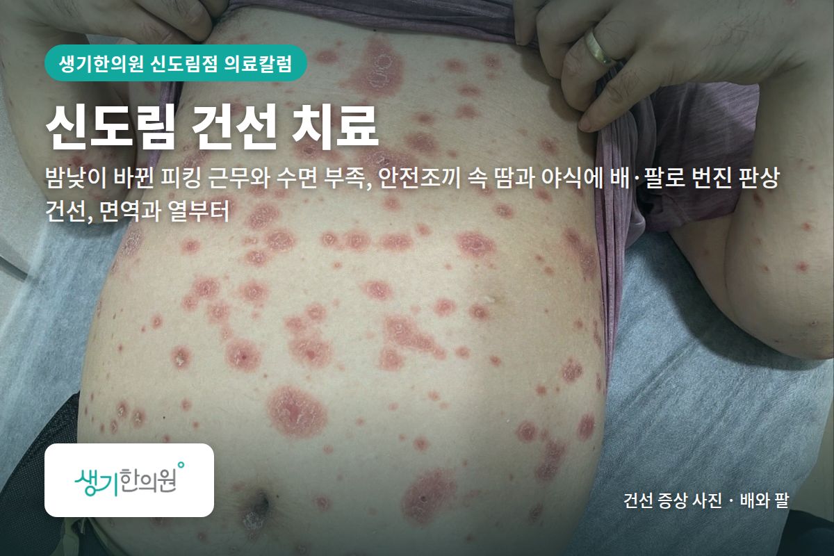배와 팔 건선 증상 사진과 문구 「신도림 건선 치료, 밤낮이 바뀐 피킹 근무와 수면 부족, 안전조끼 속 땀과 야식에 배·팔로 번진 판상 건선, 면역과 열부터 · 생기한의원 신도림점」