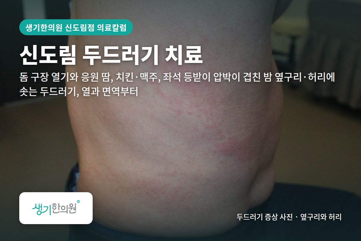 옆구리와 허리 두드러기 증상 사진과 문구 「신도림 두드러기 치료, 돔 구장 열기와 응원 땀, 치킨·맥주, 좌석 등받이 압박이 겹친 밤 옆구리·허리에 솟는 두드러기, 열과 면역부터 · 생기한의원 신도림점」