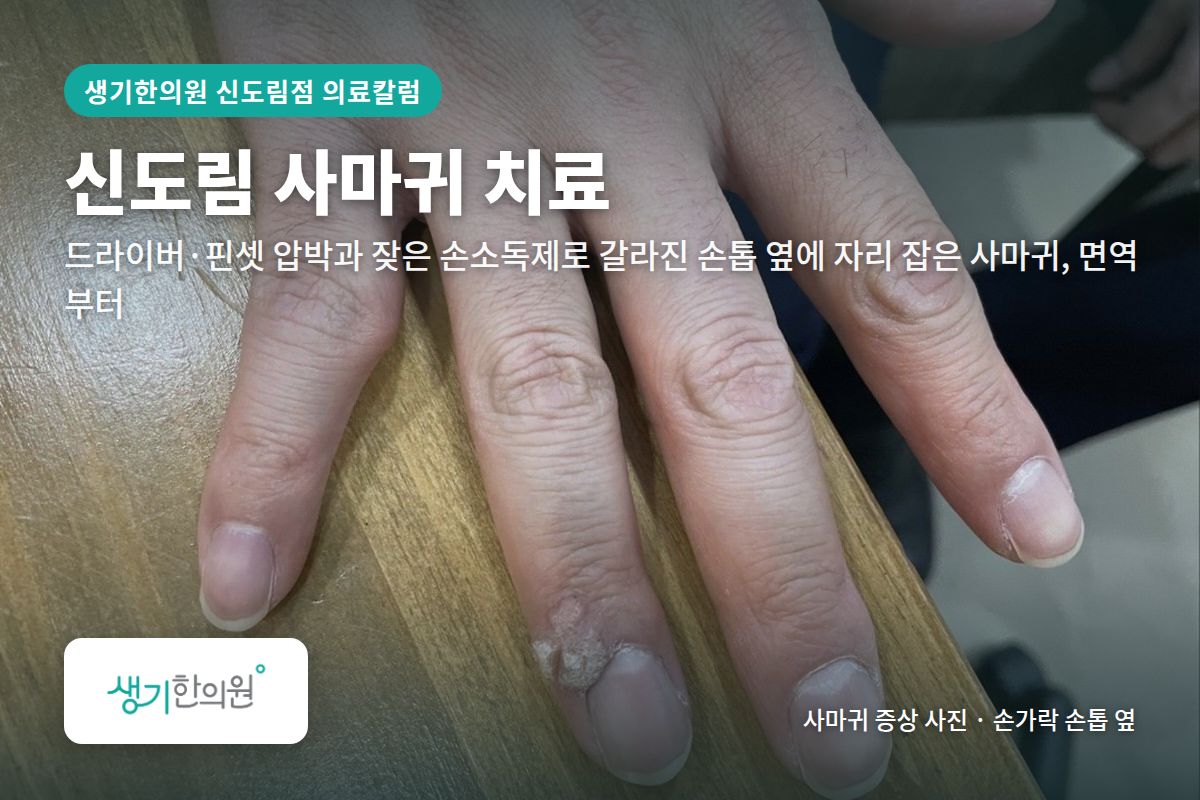 손가락 손톱 옆 사마귀 증상 사진과 문구 「신도림 사마귀 치료, 드라이버·핀셋 압박과 잦은 손소독제로 갈라진 손톱 옆에 자리 잡은 사마귀, 면역부터 · 생기한의원 신도림점」